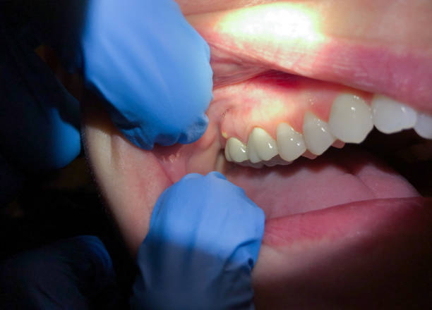 Best Emergency Tooth Extraction  in Powdersville, SC