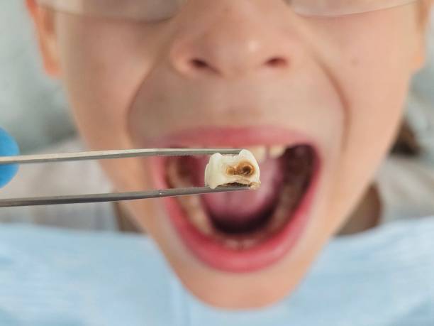 Urgent Tooth Repair in SC